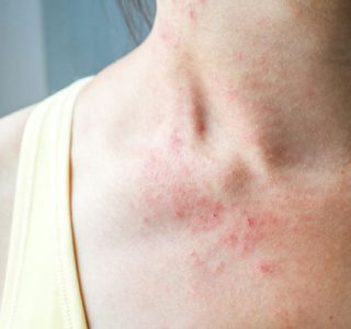 Ayurvedic skin diseases