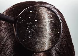 Dandruff