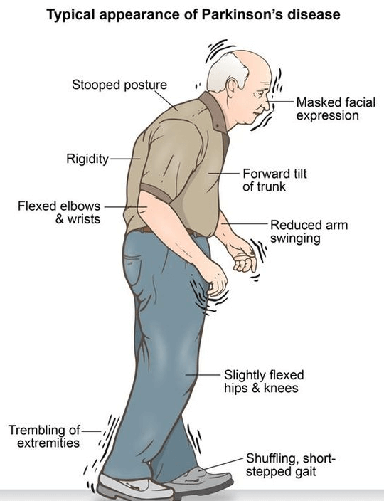 parkinsons disease