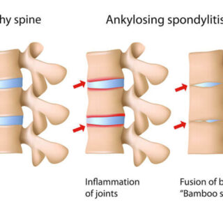 Ayurvedic Treatment for Ankylosing Spondylitis