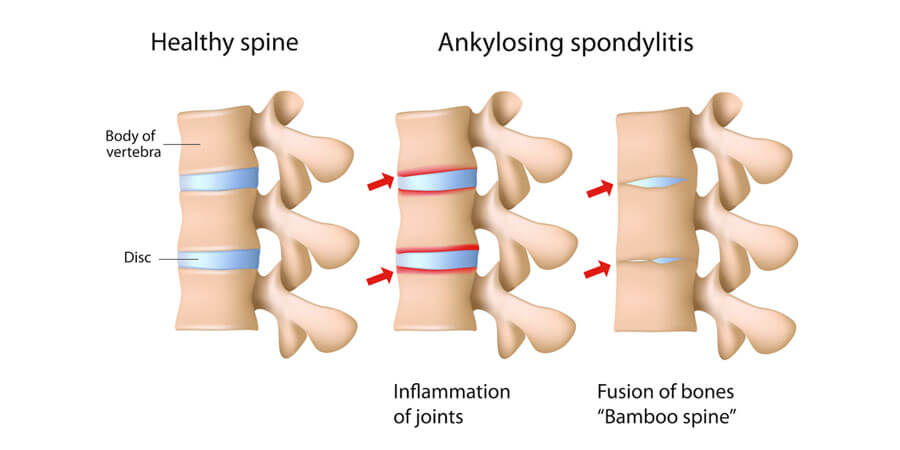 Ayurvedic Treatment for Ankylosing Spondylitis