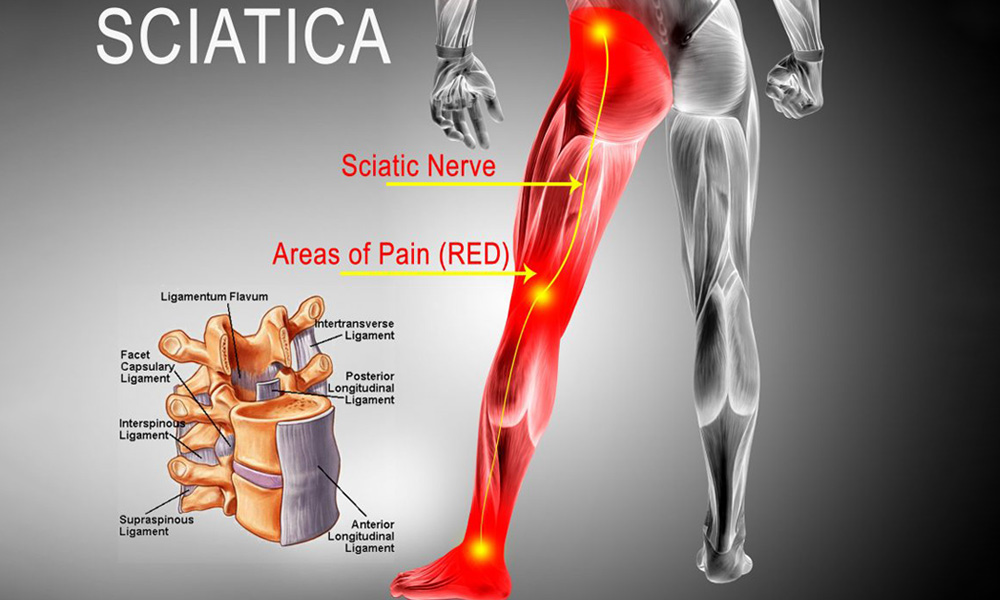 Ayurvedic Treatment for Sciatica