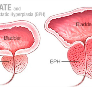 Benign Prostatic Hyperplasia