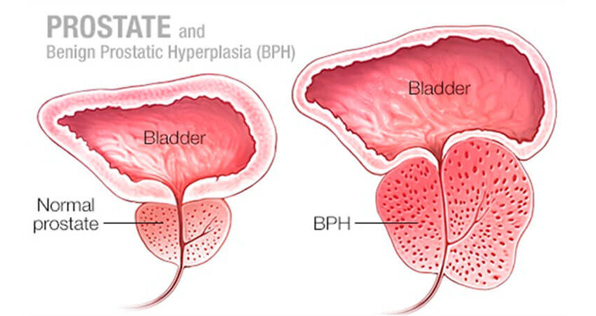 Benign Prostatic Hyperplasia