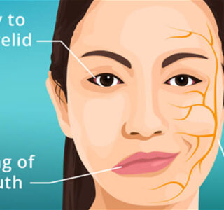 Facial Nerve Palsy