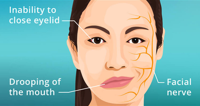 Facial Nerve Palsy