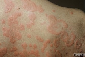 Urticaria