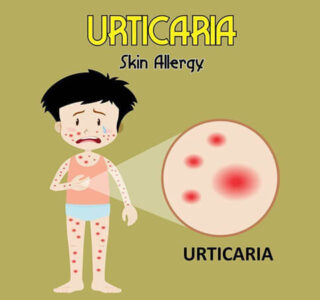 Urticaria