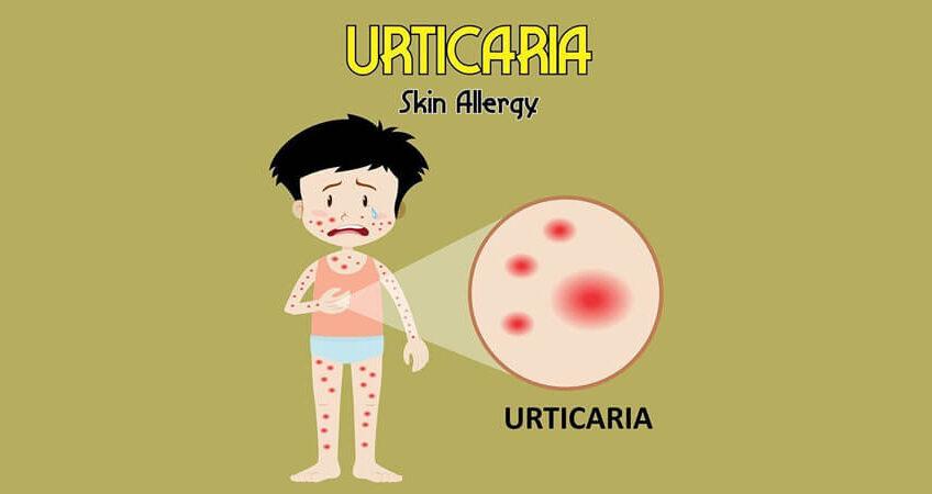 Urticaria