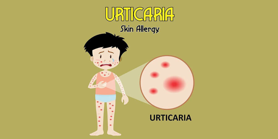 Urticaria