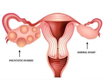 Ayurvedic Treatment for PCOS/PCOD